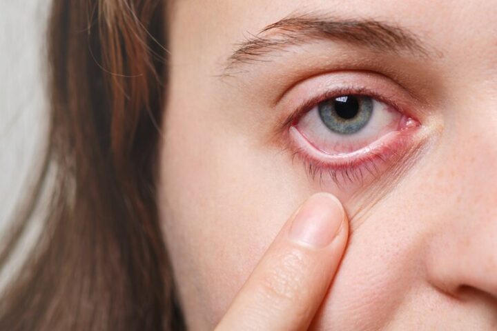 Conjuntivite: saiba sintomas e como tratar olhos