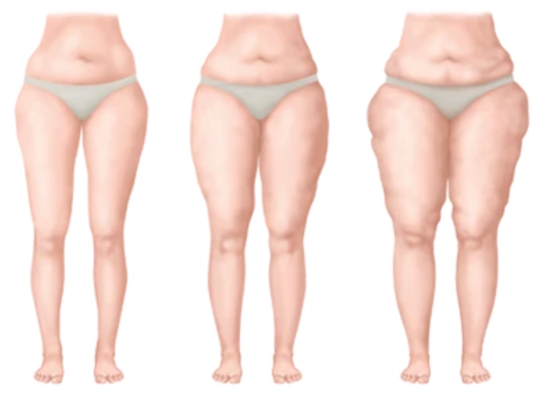 Lipedema Divulgação