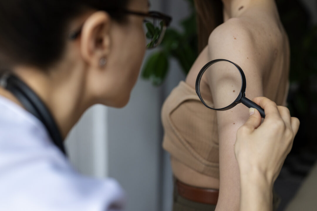 medica diagnosticando um melanoma no corpo de uma paciente sexo feminino